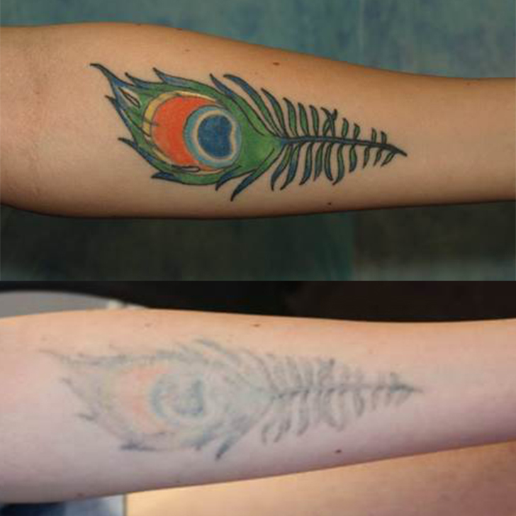 How to Get Rid of a Tattoo | POPSUGAR Beauty