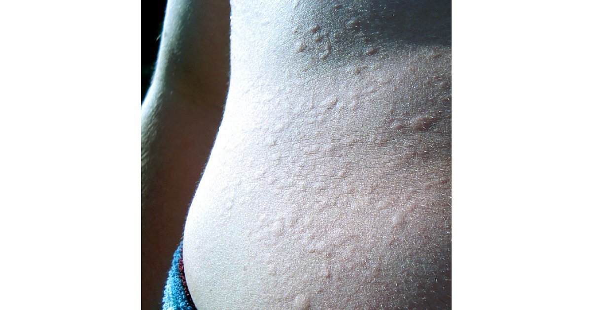 what-is-physical-urticaria-popsugar-fitness
