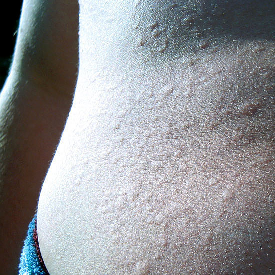 What is Physical Urticaria? POPSUGAR Fitness