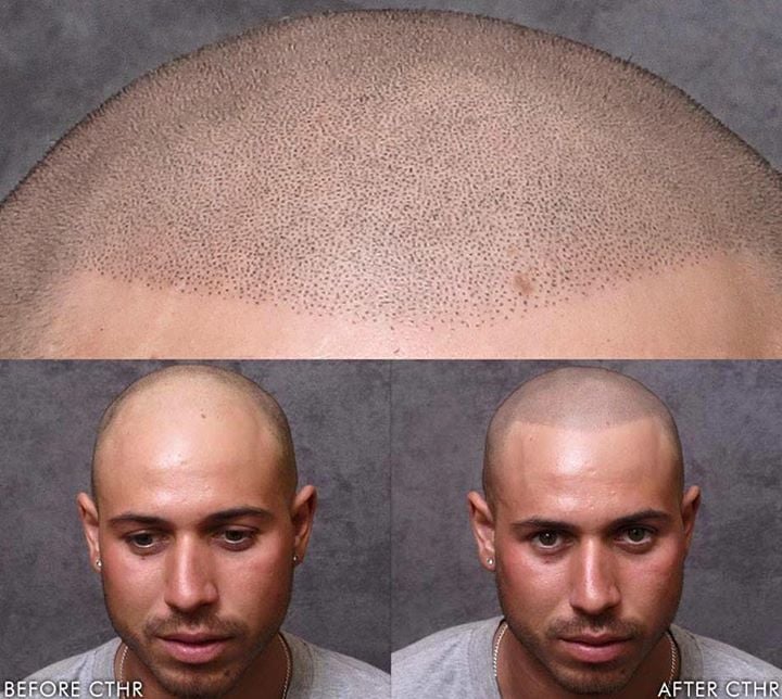 Hair Tattoos For Baldness | POPSUGAR Beauty