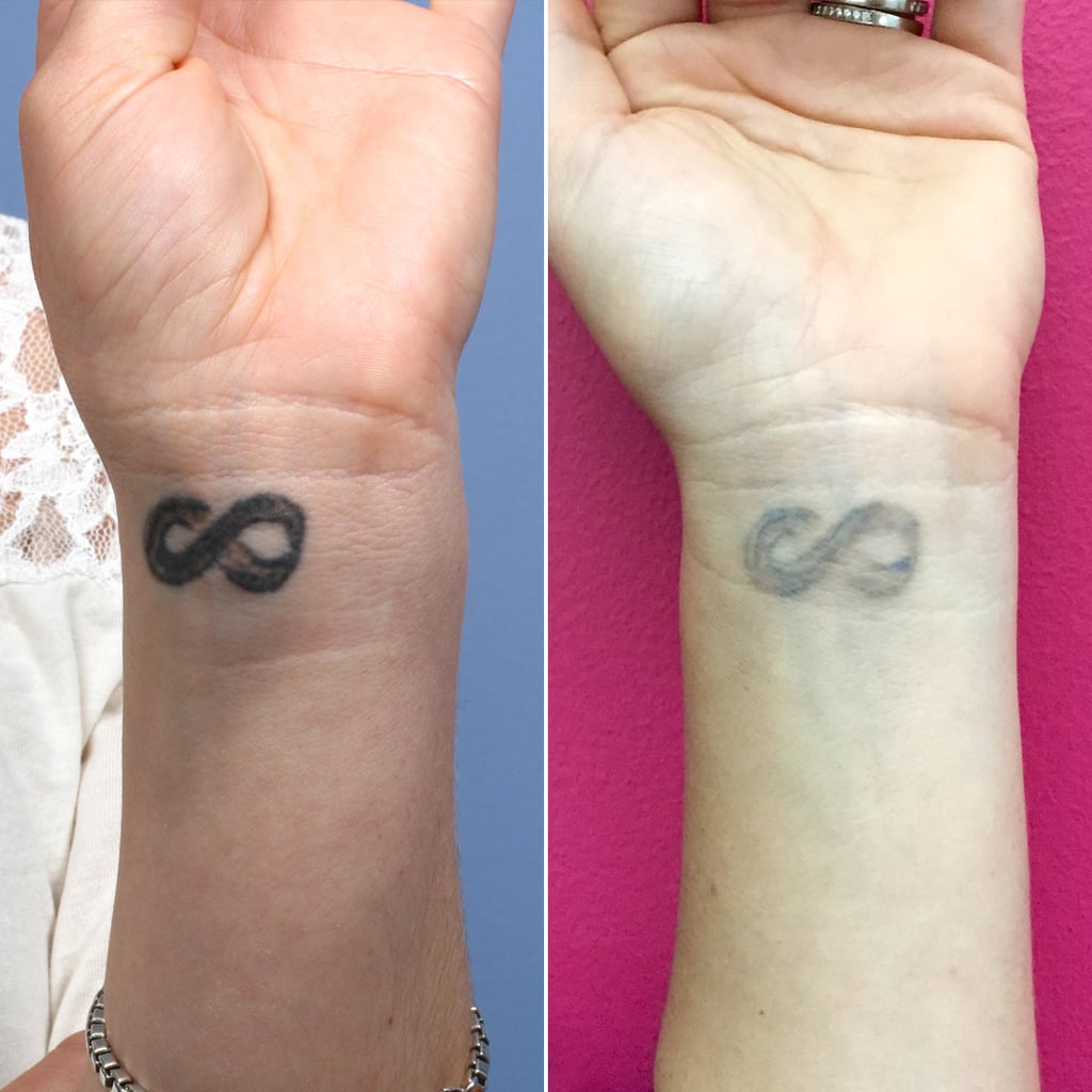 what it s like to have a tattoo removed popsugar beauty what it s like to have a tattoo removed popsugar beauty